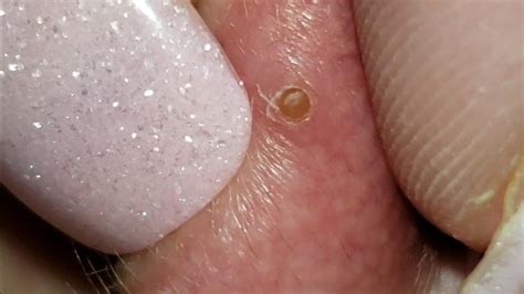 ⁣What’s up friends and welcome to see new <strong>big blackheads</strong> being <strong>popped</strong>. . Big blackhead pops